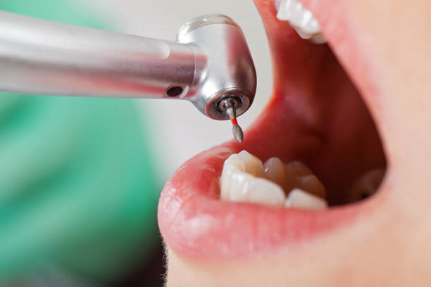 Best Emergency Wisdom Teeth Removal in Mount Ida, AR